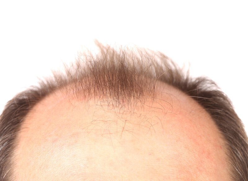 The image above would fit into the androgenetic alopecia category because it is progressive hair loss.
