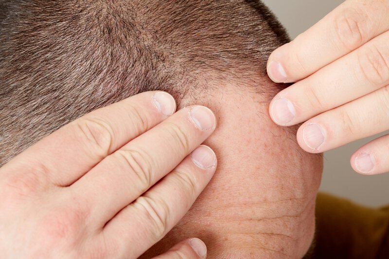 Sudden hair loss could be the result of a drug reaction or infection.
