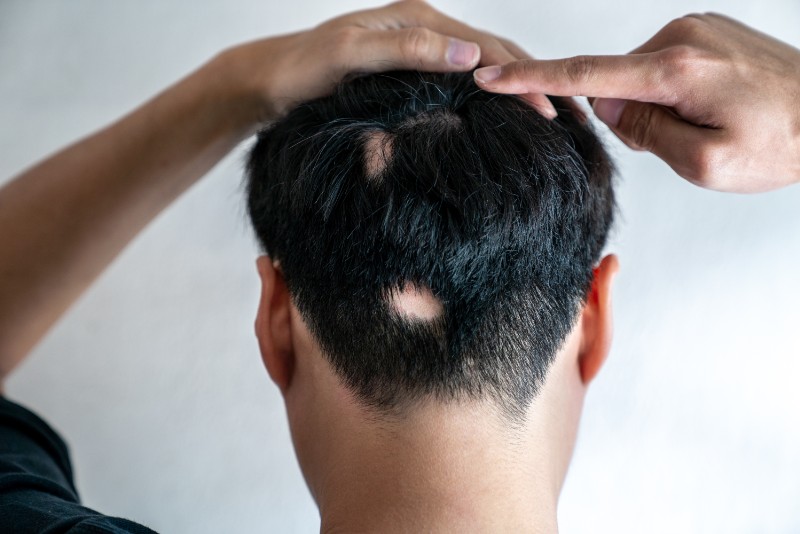 Alopecia Areata areas on man's head