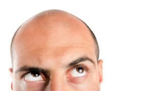 Why do only some men experience hair loss?