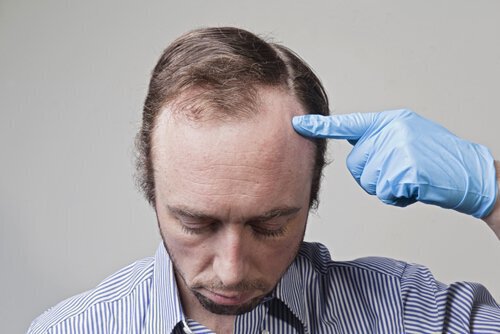 How to evaluate your hair loss