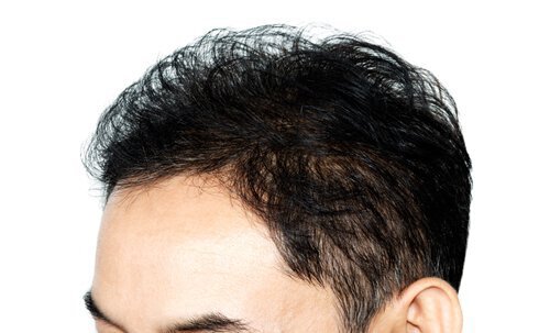 Medical hair restoration has come a long way in recent years.