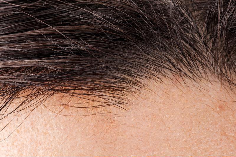 A hair transplant looks natural because it is your own hair that will grow in.